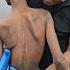 Scoliosis Treatment Drrajneeshkant WorldfamousChiropractor