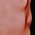 Mother On Marivan Warfarin With Increased Frontonasal Angle Fetal Warfarin Syndrome