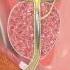 Urinary Catheterization Procedure Shorts