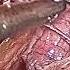 Laparoscopic Hystero Pectopexy
