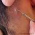 Terminal Hair In Scalp
