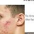 Facts You Should Know About Masturbation And Acne Drashimagoel Parisaskinclinic Youtubeshorts