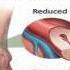 DIABETIC NEUROPATHY Diabetic Foot