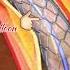 Angioplasty Angiography Coronary Angioplasty Who Worldhealthorganization Angioplasty