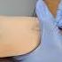Mantoux Tuberculin Test PATHOLOGY Life Sterlingaccurisdiagnostics