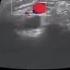 Acute Appendicitis Radiology Ultrasound