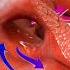 Blue Baby Heart Defect Tetralogy Of Fallot