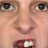 Can Braces Make Your Teeth FALL OUT