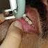 Fractional CO2 Laser For Vitiligo Dr Priyanka Agarwal