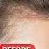 Shocking Truth About Hair Loss You Don T Want To Miss