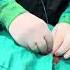 Portex Percutaneous Dilation Tracheostomy