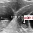 Single Fetal Demise In Twin Pregnancy Called Vanishing Twin Syndrome And Fetus Papyraceus