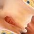 Anal Fissure Laser Surgery Treatment Viral